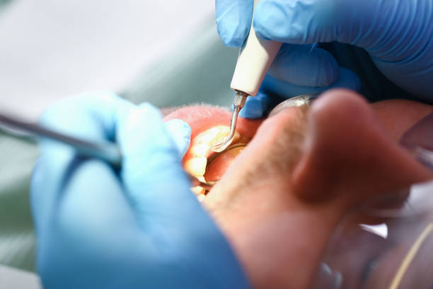 Best Emergency Wisdom Teeth Removal in Winnsboro, LA