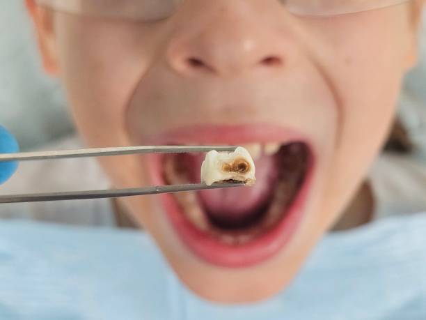 Best Emergency Treatment for Toothache in Winnsboro, LA